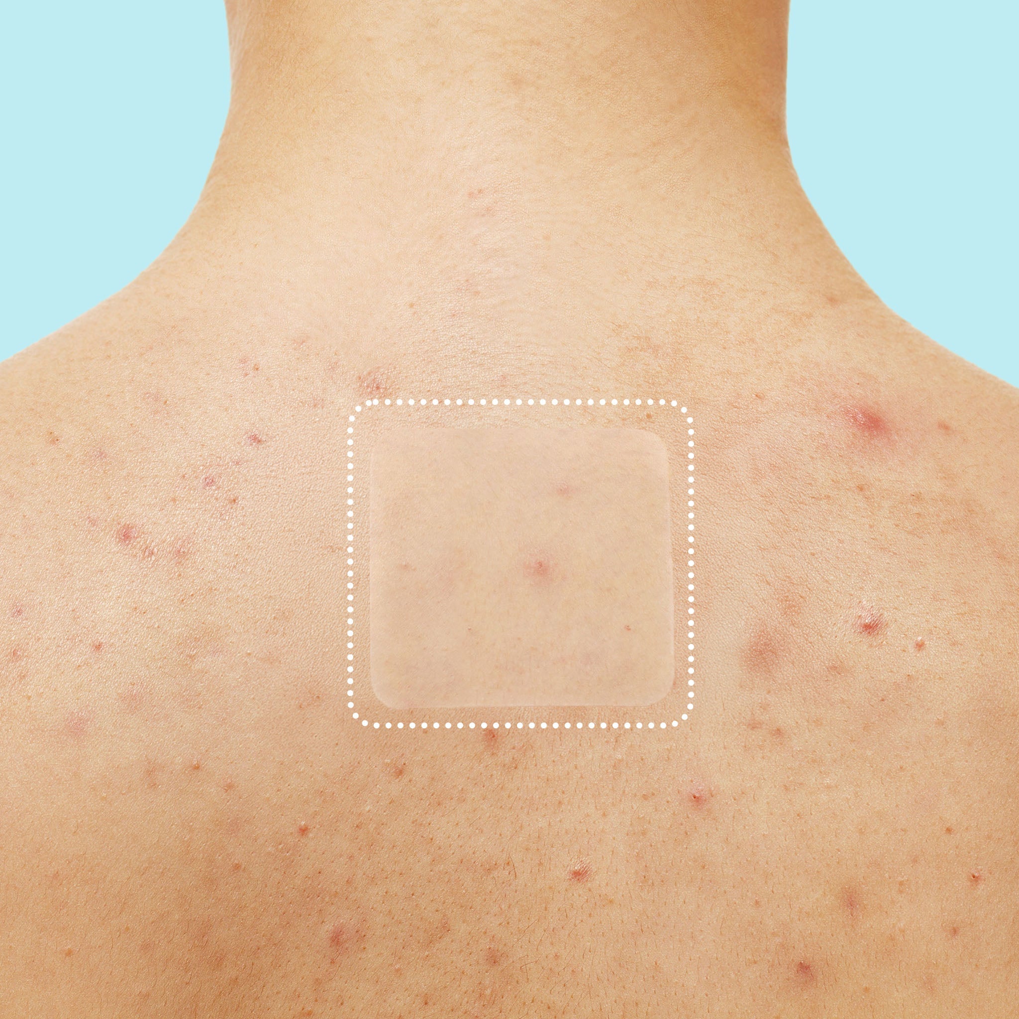 Miracle Patch XL Spot Control Cover